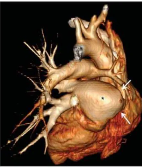 Figure 3. Axial reconstruction of contrast-enhanced chest computed tomog- tomog-raphy with maximum intensity projection (MIP), demonstrating reduction of right pulmonary artery caliber (black arrow) and prominence of bronchial arteries (white arrow).