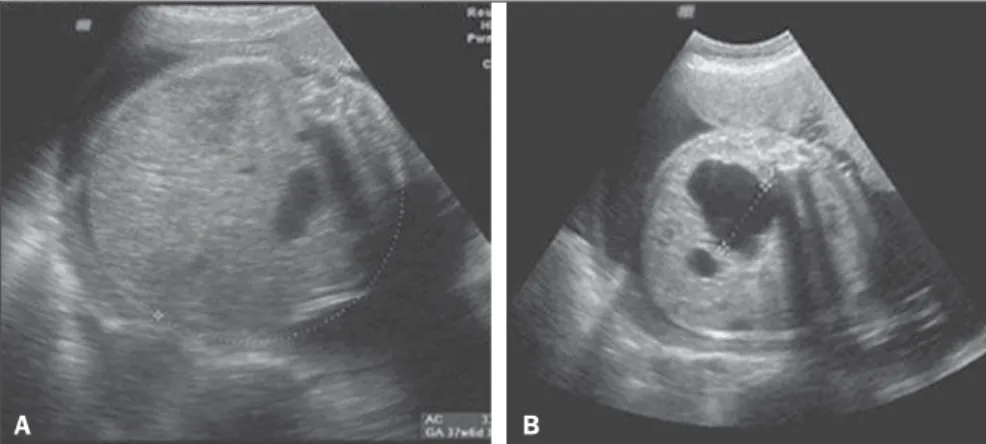 Figure 1. 2DUS findings in a fetus with BWS at the 28th gestational week. A: Abdominal circumference compatible with a gestational age of 37 weeks and six days (> the 98th percentile)