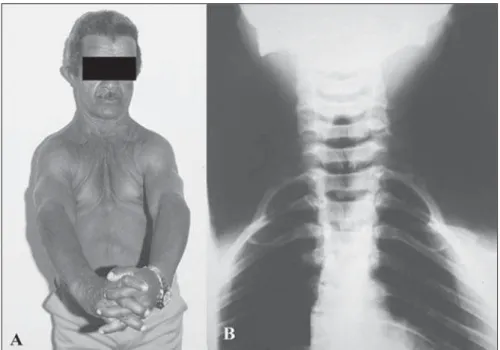 Figure 4. A: Abnormal shoulders mobility. B: Radiography demonstrating bilateral clavicular hypoplasia.