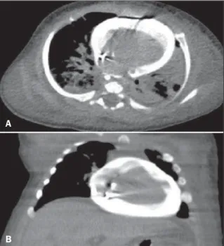 Figure 1. Contrast enhanced chest computed tomography images. A: