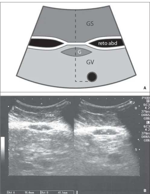 Figure 1. A: Scheme of measurements of subcutaneous and visceral fat thickness. B: Sonographic im- im-age showing measurements of subcutaneous and visceral fat thickness.