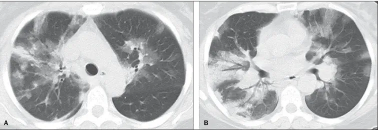 Figure 1. HRCT showing areas of consolidation and ground-glass opacities in the upper (A) and lower lobes (B) of both lungs.