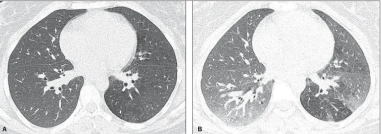 Figure 3. Axial HRCT (inspiration) (A) and expiration (B) identifying air trapping in the lower lobe of the left lung.