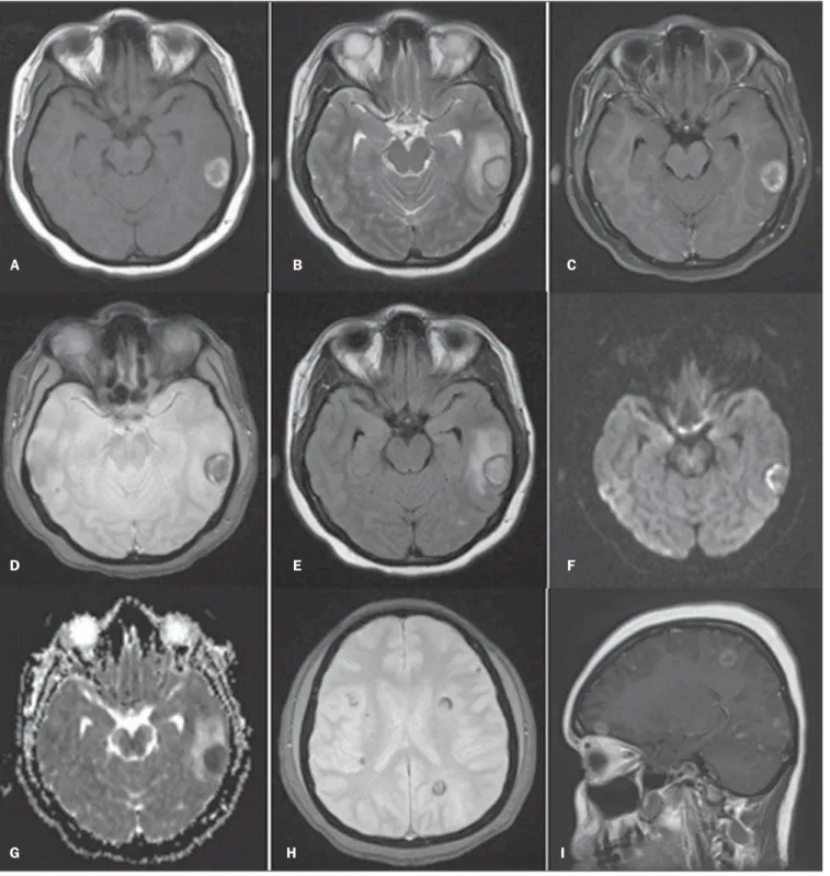 Figure 1. Cranial MRI. A: Axial, T1-weighted image – cortical-subcortical, expansile, nodular lesion in the left temporal lobe with a central isointense component and hypersignal halo