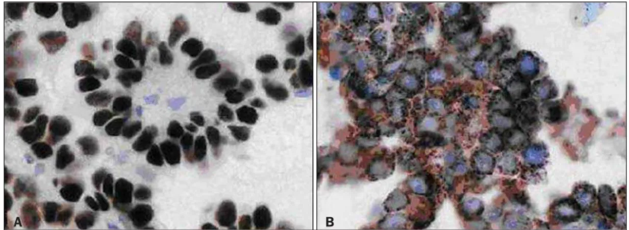 Figure 2. Image showing immunohistochemistry test results with positive markers for TTF-1 (A) and napsin-A