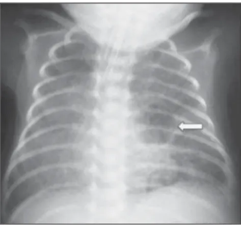 Figure 1. Anteroposterior chest radiography. Bilat- Bilat-eral, hypoattenuating, serpentiform, tubular  im-ages, different from the air bronchogram pattern.