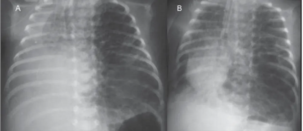Figure 3. Axial chest computed tomography. A: Multiple cystic, predominantly round images in associa- associa-tion with linear (arrow heads) and punctate (arrows) images – lines and dots pattern