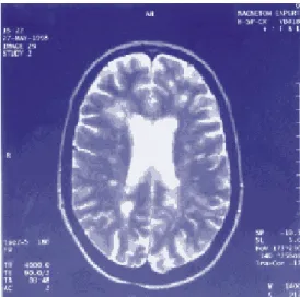 Figura 2. Imagem do cérebro resultante de uma Ressonância nuclear magnética. 