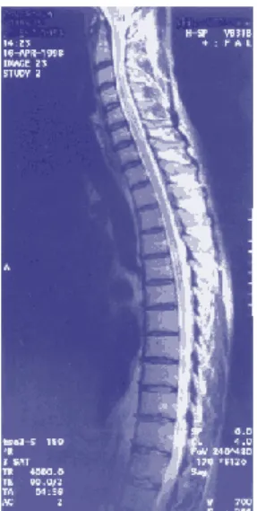 Figura 3. Imagem da medula espinal resultante de uma Ressonância nuclear magnética. 