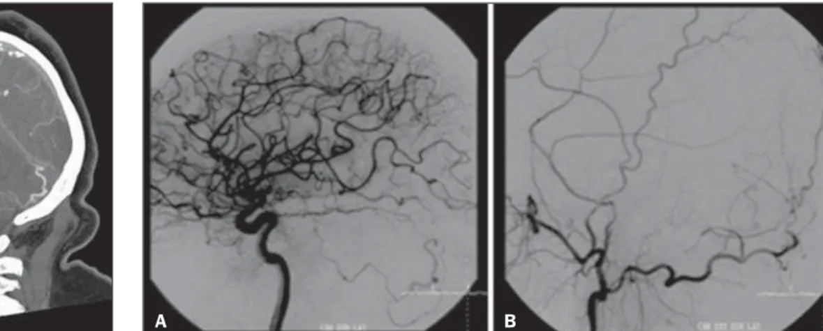Figure 1. Head unenhanced computed tomography (CT). A: Axial slice. B: Sagittal reformation image.
