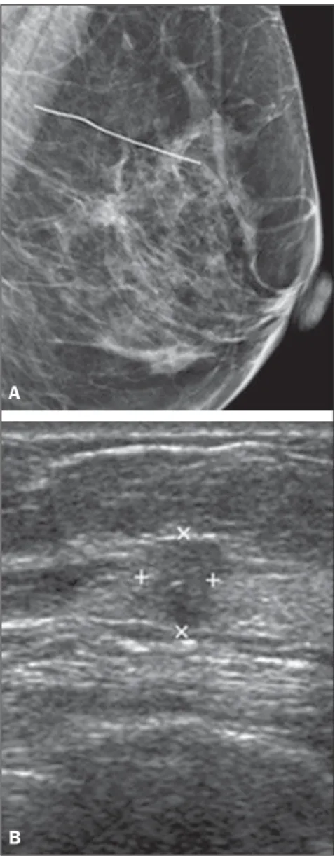 Figure 1. Non palpable nodules located in the axillary extension of the left breast in a 63-year-old woman.