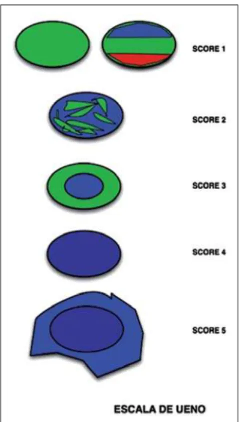 Figure 1. Ueno score system, where elasticity lev- lev-els are schematically demonstrated (13) .