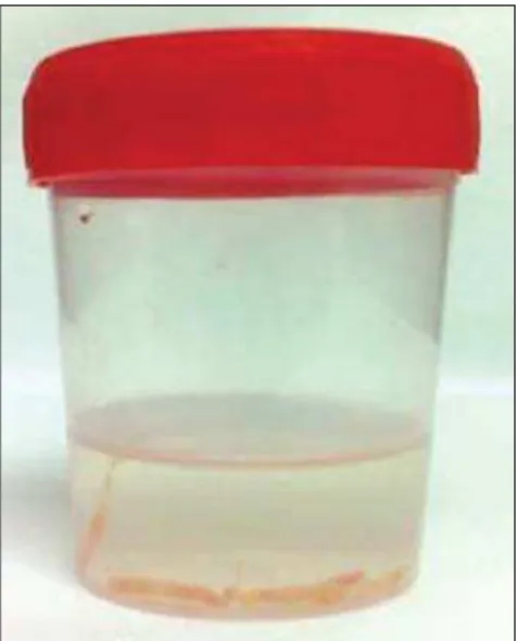 Figure 5. Appropriate specimens of breast core biopsy: predominantly white, integral and sinks in the solution.