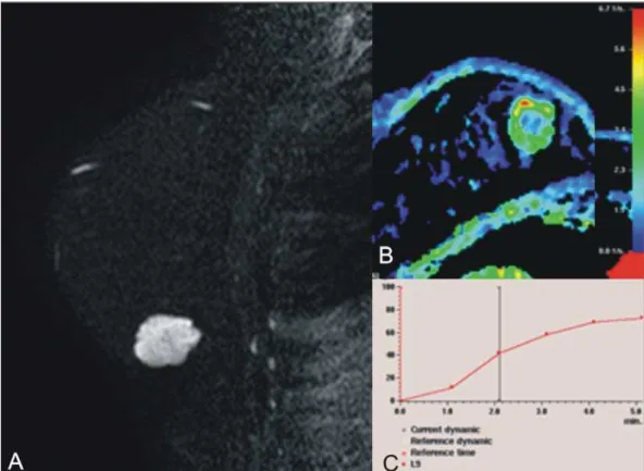 Figure 5. Female, 54-year-old patient with pure mucinous tumor represented on diffusion-weighted im- im-ages, with b value = 0 on A and b = 700 on B, revealing minimum restriction, corroborated by the high signal intensity on C (ADC map).