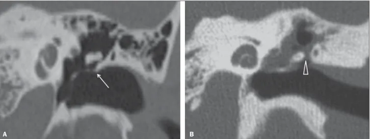 Figure 2. MSCT with coronal multiplanar reconstruction. A: Lateral wall of the attic/intact bone spur of Chausse (arrow)