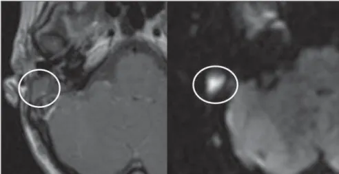 Figure 4. Axial MRI, delayed, contrast-enhanced T1-weighted sequence. Inflammatory  tissue/granu-lation with intense contrast uptake (asterisk)