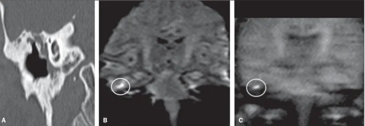 Figure 8. A: MSCT with coronal multiplanar reconstruction: Thinning with bone destruction of the tympanic tegmen (oblique arrow) in association with labyrinth fistula (hollow arrow)