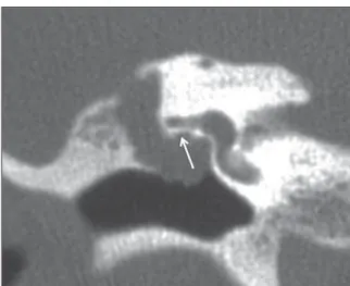 Figure 9. MSCT with coronal multiplanar reconstruction. Bone lysis of the facial nerve tympanic segment (arrow).