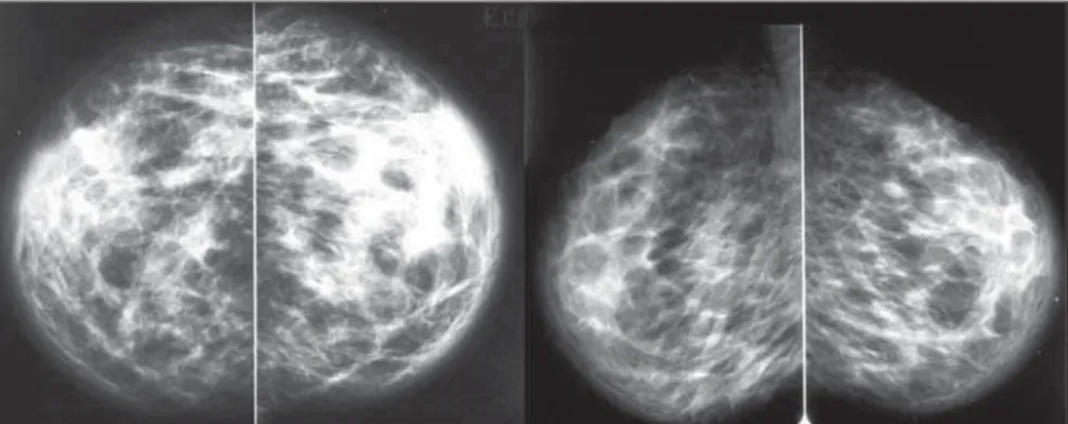 Figure 1. Mammography, bilateral craniocaudal and mediolateral oblique views with parenchymal evalu- evalu-ation technique