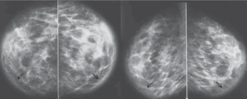 Figure 3. Contrast-enhanced chest computed tomography, coronal and sagittal sections. Ill-defined mediastinal mass with invasion of the superior vena cava (arrows).