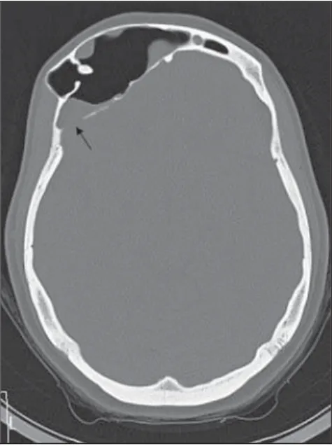 Figure 1. Cranial CT scan, lateral view. Extensive pneumatization of the frontal sinus.