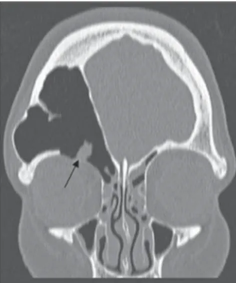Figure 4. Coronal CT, soft-tissue window. Presence of material with soft parts density in the frontal  si-nus at right.