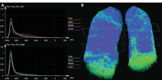 Figure 3. Evaluation of pulmonary density in the upper, middle and lower thirds of the lung (A) and 3D  reformat-ting of the lungs with color mapping demonstrating the relative densities and planes of the upper, middle and lower thirds of the lung (B).