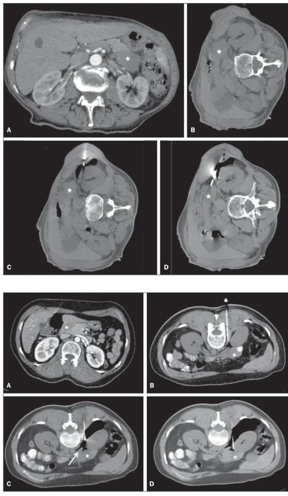 Figure 1. Male, 82-year-old patient submitted to CT-guided  percutane-ous biopsy of a pancreatic mass, with lateral approach and  pneumodis-section maneuver