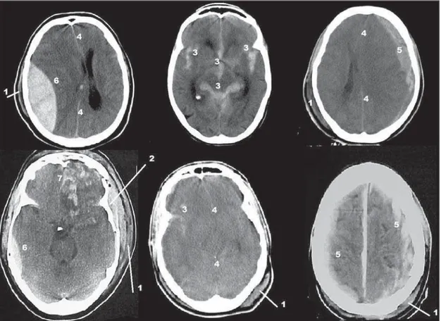 Figure 1. 1, extracranial soft-tissue swelling; 2, depressed bone fracture; 3, subarachnoid hemorrhage; 4, midline structures displacement/diffuse cerebral edema; 5, subdural hematoma; 6, epidural hematoma; 7, cerebral contusion in frontal pole (straight a