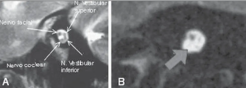 Figure 4. Sagittal MRI T2-weighted images. A: Anatomical distribution of the nerves inside the internal auditory canal