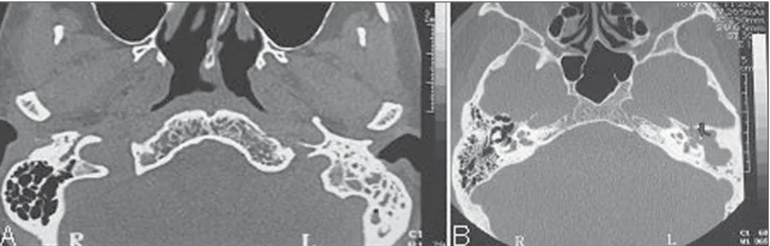 Figure 10. A: Curve reconstruction along the entire normal osseous neural canal of the facial nerve, demonstrating that it is caudally located in relation to the lateral semicircular canal (CAI, internal auditory canal) B: Oblique reconstruction demonstrat