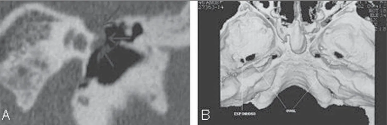 Figure 12. A: Coronal CT reconstruction demonstrating persistent stapedial artery at left: enlargement of the facial nerve canal, with projection of the artery towards the middle year (arrows)