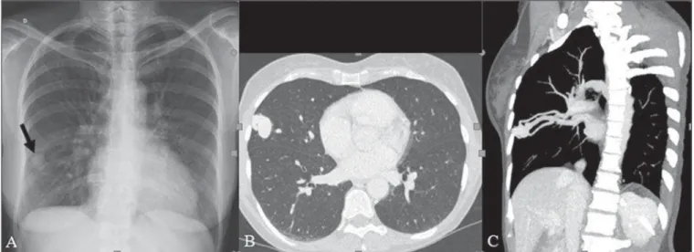 Figure 1. A: Posteroanterior chest radiography showing nodule with soft-tissue density in the right lung (arrow)