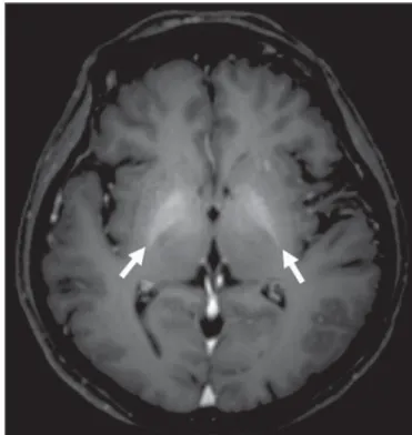 Figure 4. Axial brain MRI T1-weighted section demonstrating the presence of hypersignal in the globus pallidus (arrows), compatible with manganese  depo-sition, confirming the presence of portosystemic shunt.