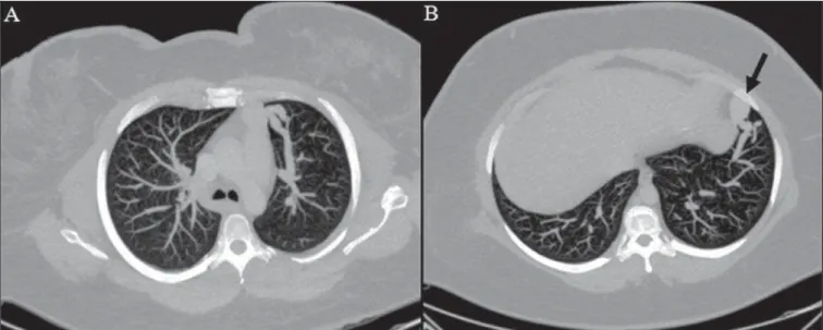 Figure 7. Axial chest CT with maximum intensity projection (MIP) algorithm demonstrating anomalous calibrous vessels in the pulmonary parenchyma (A), nodule in the anterior costophrenic sinus in continuity with dilated serpiginous vessels (B), characterizi