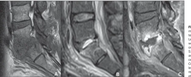 Figure 1. Segmental involve- involve-ment of L5-S1 and of the  in-terposed intervertebral disc.