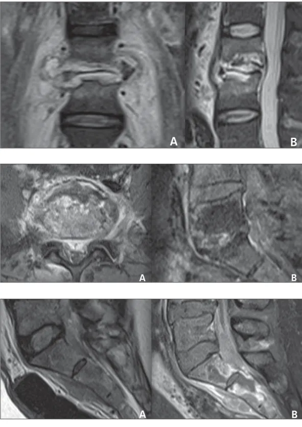 Figure 2. Segmental involve- involve-ment of L3-L4 and of the  inter-posed intervertebral disc in the coronal (A) and sagittal planes (B)