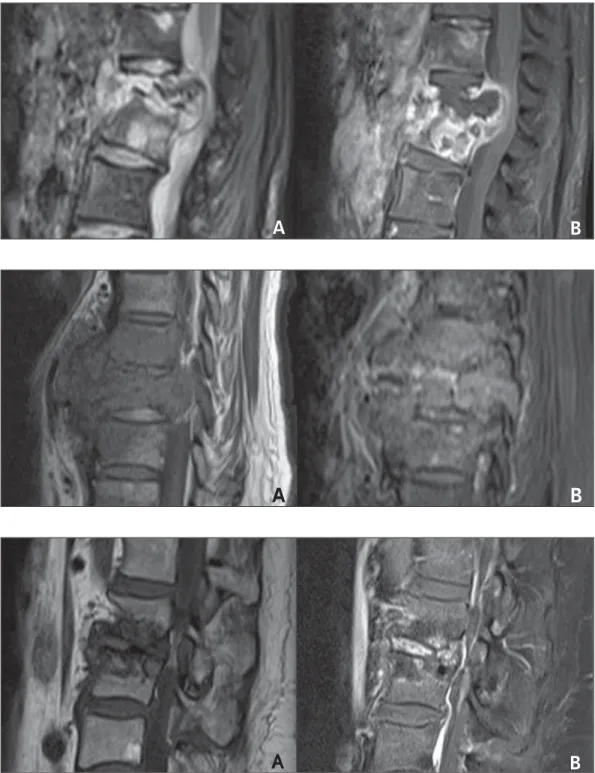 Figure 5. Multisegmental in- in-volvement. Total collapse of L1 and partial collapse of L2 in  as-sociation with heterogeneous medullary space enhancement following intravenous gadolinium injection, demonstrating the presence of intraosseous  ab-scess at L