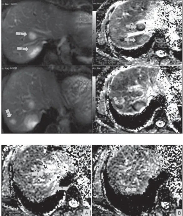 Figure 1. Magnetic resonance of the liver – image acquired on March 22, 2011. Liver metastases visualized on diffusion-weighted sequence (at left) and respective apparent diffusion coefficient  val-ues on the ADC mapping (at right) previously to the chemot