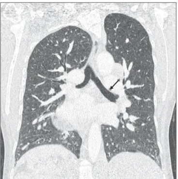 Figure 1. Chest computed to- to-mography angiography  demon-strating dextrocardia,  cardiome-galy and atrial septal defect (arrow).