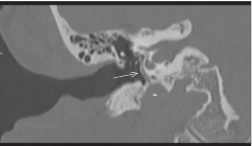 Figure 1. Multislice computed tomography image with coronal reconstruction. Persistent stapedial artery (arrow) originating from the internal carotid artery (asterisk), with an ascending course adjacent to the cochlear promontory, passing through the oval 