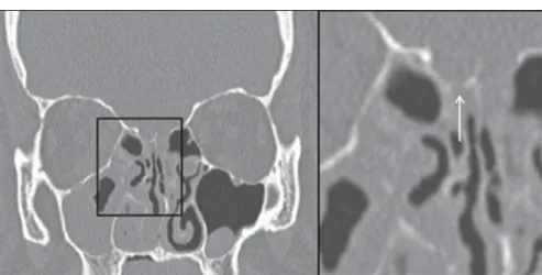 Figure 1. Bone window computed tomography with coronal reconstruction of paranasal sinuses