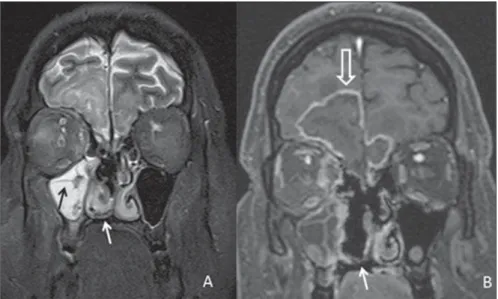 Figure 3. Contrast-enhanced axial magnetic reso- reso-nance imaging T1-weighted sequence  demonstrat-ing asymmetrical uptake by the cavernous sinuses (arrow).