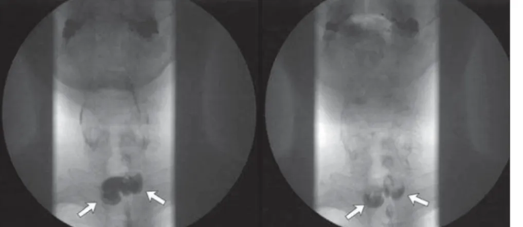 Figure 1. Frontal views demonstrate two lateral prominences (arrows) corresponding to Killian-Jamieson diverticula.