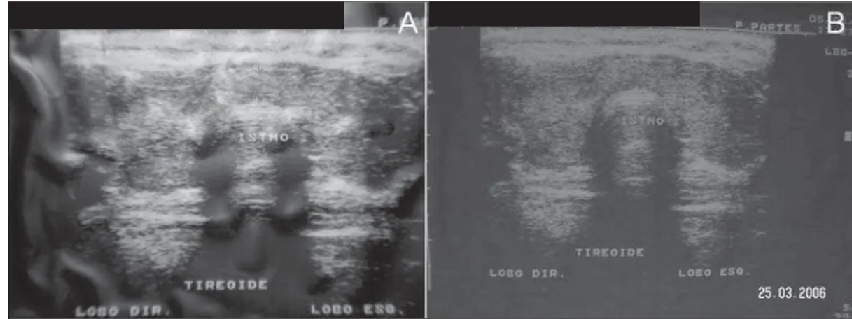 Figure 4. Patient 1. A: Pre- Pre-embolization   ultrasonogra-phy, with a volume of 64 ml.;