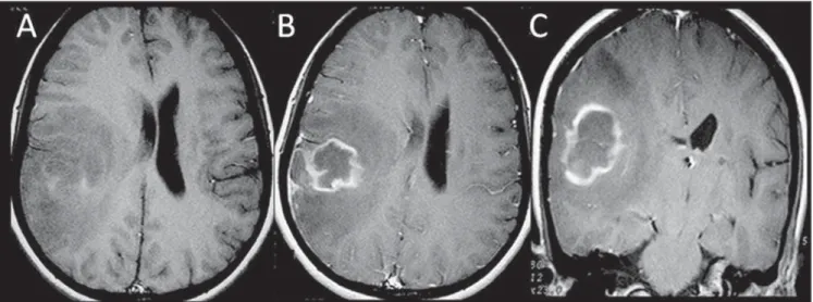 Figure 4. Female, 32-year-old, HIV positive patient. Axial T1-weighted image (A) demonstrates right parietotemporal lesion with high signal components (hem- (hem-orrhage)