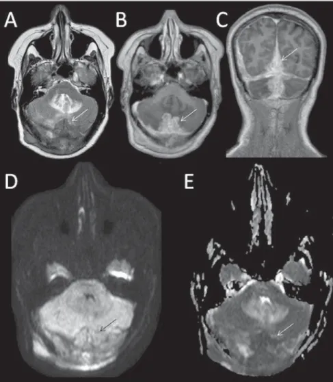 Figure 6. Female, 52-year-old patient. Images show diffuse supra and infratentorial dural (pachymeningeal) thickening at median right region, with hyposignal on T2-weighted image, homogeneous  contrast-en-hancement (C), hypersignal on diffusion-weighted im