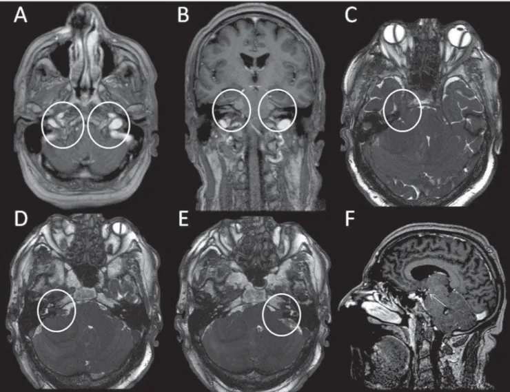 Figure 10. Same case as on Figure 9. Post-contrast axial T1-weighted image (A) demonstrates thickening and enhancement of the cranial nerve XI, bilaterally.