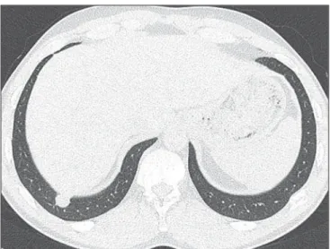 Figure 2. Coronal reformation of the small cavitary lesion demonstrating the extent of the adjacent ground-glass opacities.