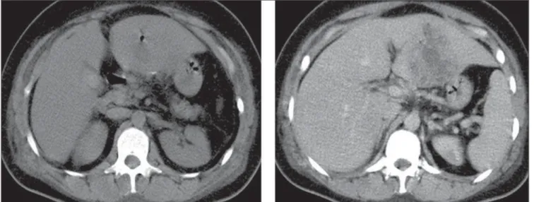 Figura 1. Tomografia computadorizada do abdome antes e após a administração do meio de contraste intravenoso.
